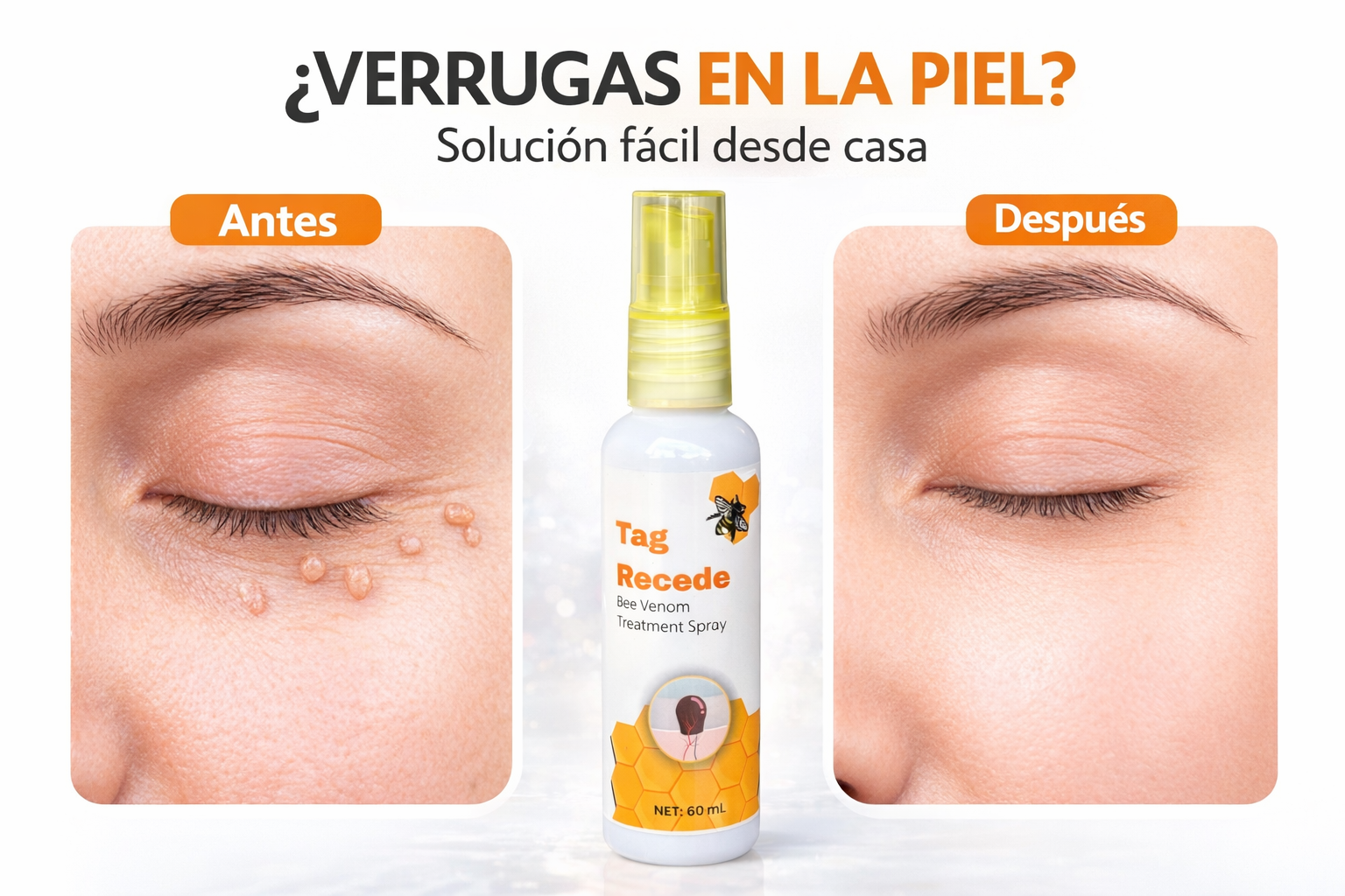 Tag Recede  Spray para eliminar verrugas