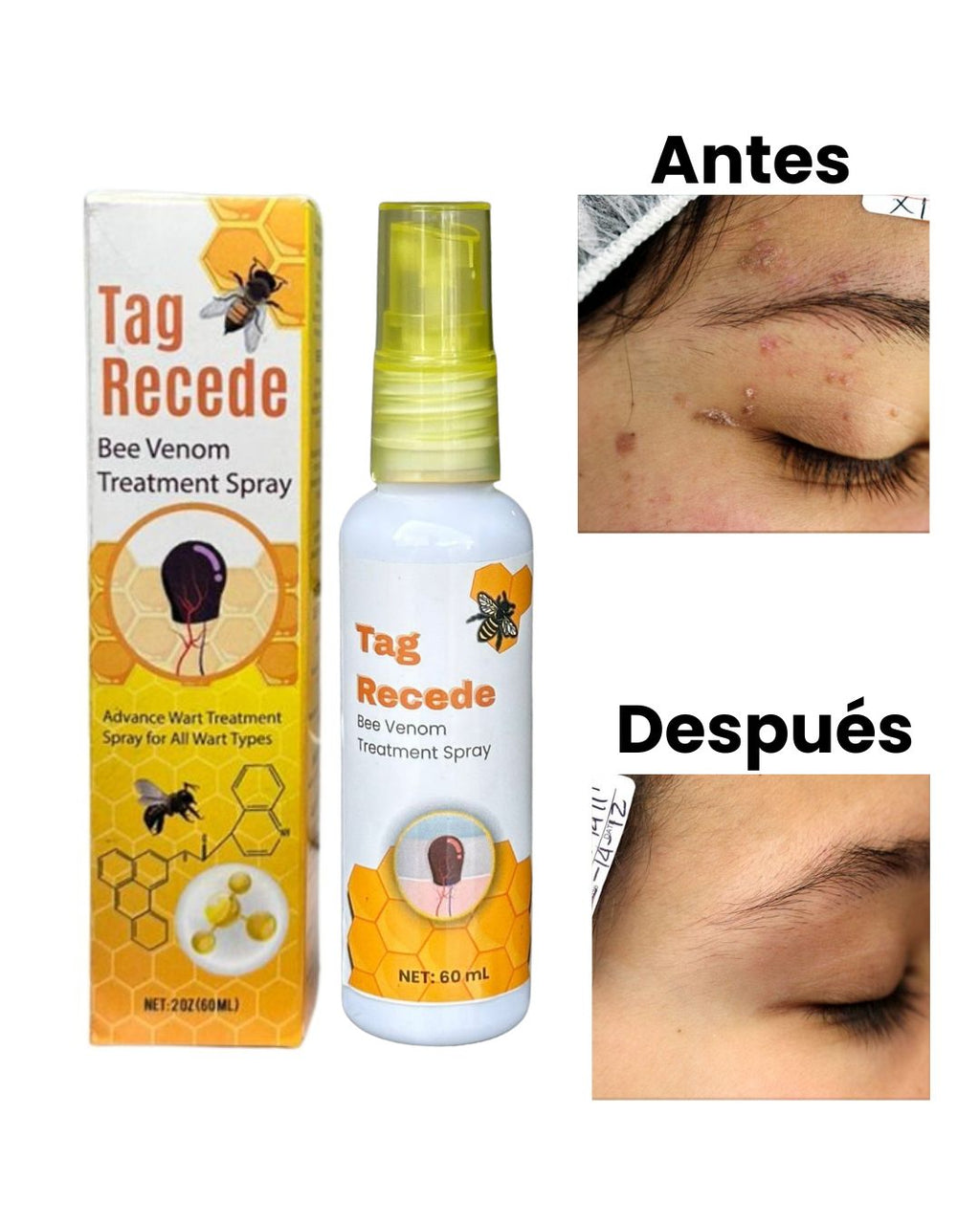 Tag Recede  Spray para eliminar verrugas